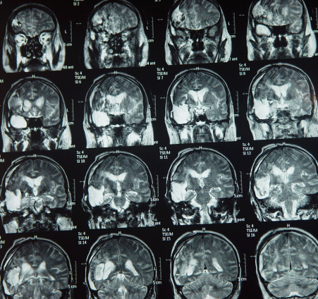 MRI TW2 Frontal view, showing the ambient spaces.