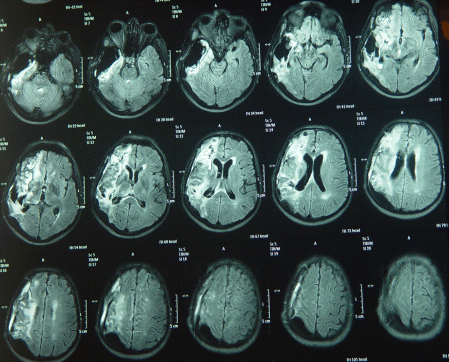 MRI TW1 demonstrating  the regression of the tumor and the Gliadel still seen.