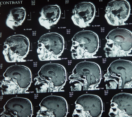 Sagittal MRI TW1 confirming the regression of the tumor.
