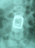 AP-view of the device with sublaminar wires.