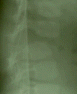 Lateral view X-ray showing the fracture dislocation.