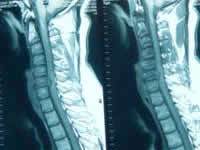 Cervical MRI T1W sagittal