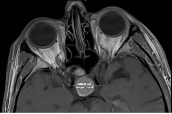 MRI of the sella TW1 axial with contrast
