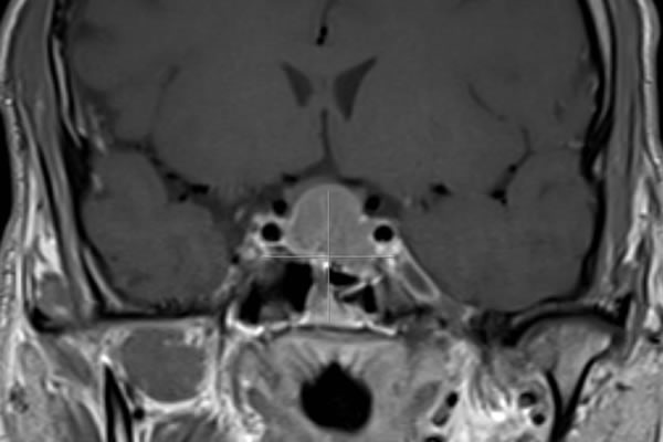 MRI sella coronal TW1 with contrast