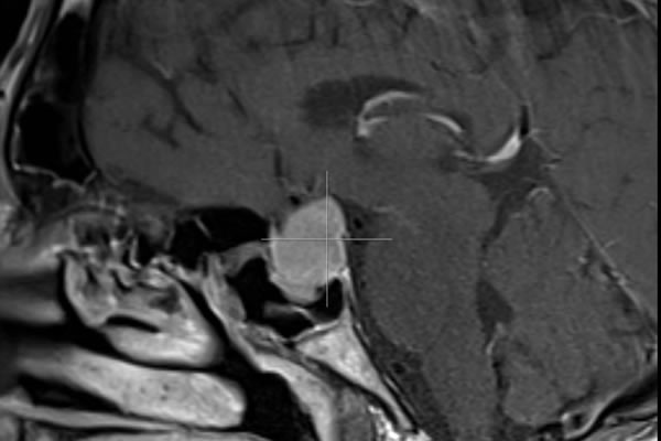 MRI sella TW1 sagittal with contrat.