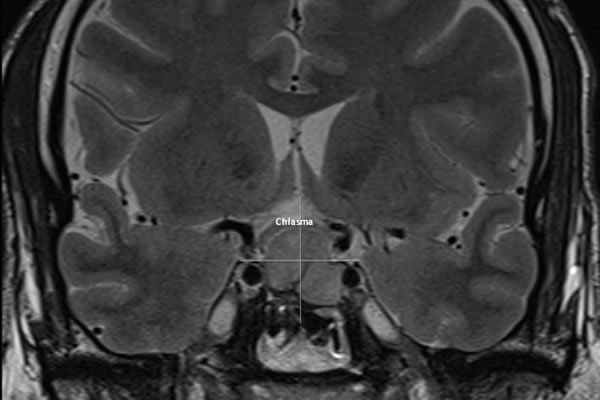 MRI sella coronal TW2