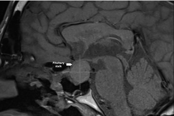 MRI sella TW1 sagittal 