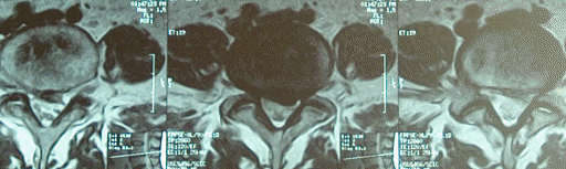 Preoperative extrusion of L4-5, causing drop left foot.