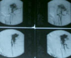 Angiogram during embolization 