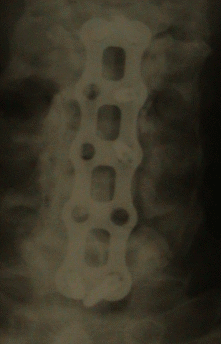 Cervical X-ray: AP view 