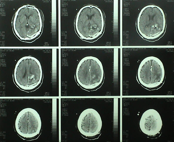 Immediate postoperative check CT-scan