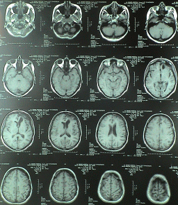 T1W MRI transverse sections