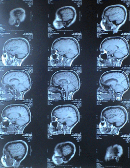 T1W sagittal sections