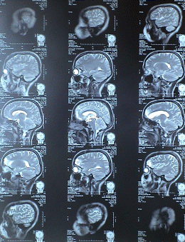 T2W sagittal sections