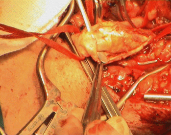 Exposure of the atheroma in the CCA.