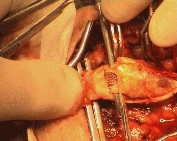 The lower edge of the stent is seen inside the atheroma.