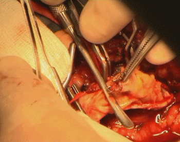 The stent and atheroma completely occluding the ICA.
