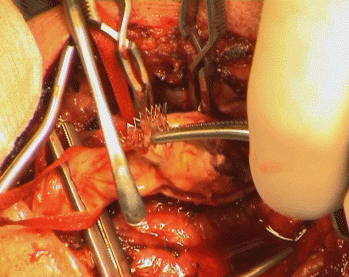 Fine dissection is going on.