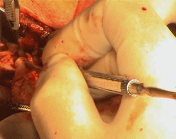 The atheroma is dissected from th ECA.