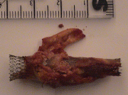 The same from anterior after bisecting the atheroma.