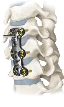 Trinica Zimmer cervical miniplate