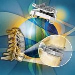 Medtronic Prestige LP Cervical disc system