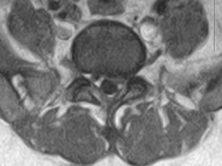 Axial T1W MRI