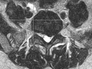 Axial T2W MRI