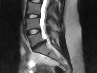 Sagittal T2W MRI