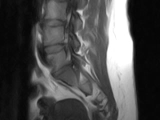 Sagittal T1W MRI