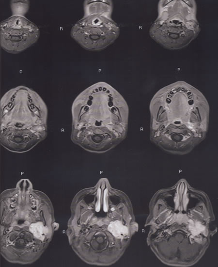 T1W Axial MRI with contrast