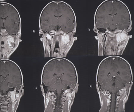 T1W Frontal MRI