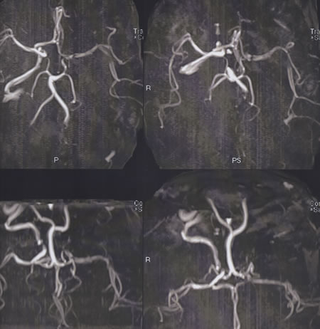 Brain MRA showing no left ICA.