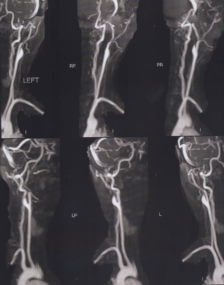 MRA of the neck showing no ICA.