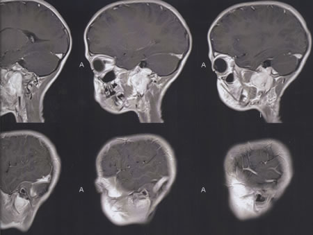 T1W Saggital MRI