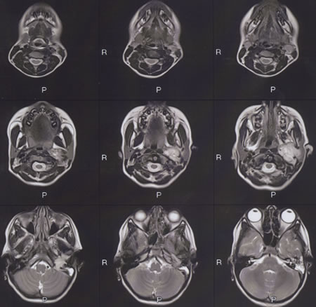 T2 W Axial MRI