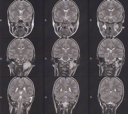 T2 W Frontal MRI