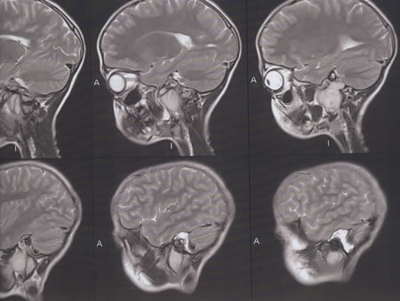 T2 W Saggital MRI