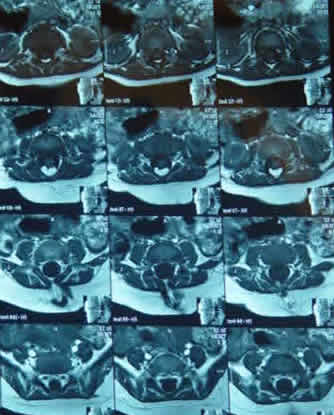 T1W Axial MRI