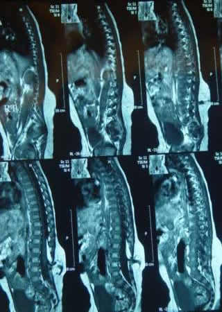 T1W Sagittal MRI